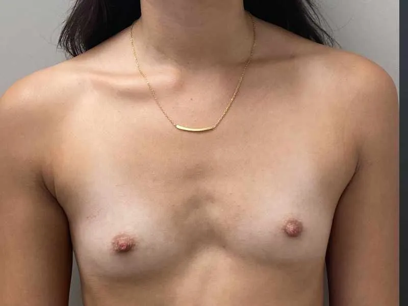 Breast Augmentation before — Breast Augmentation, view 1