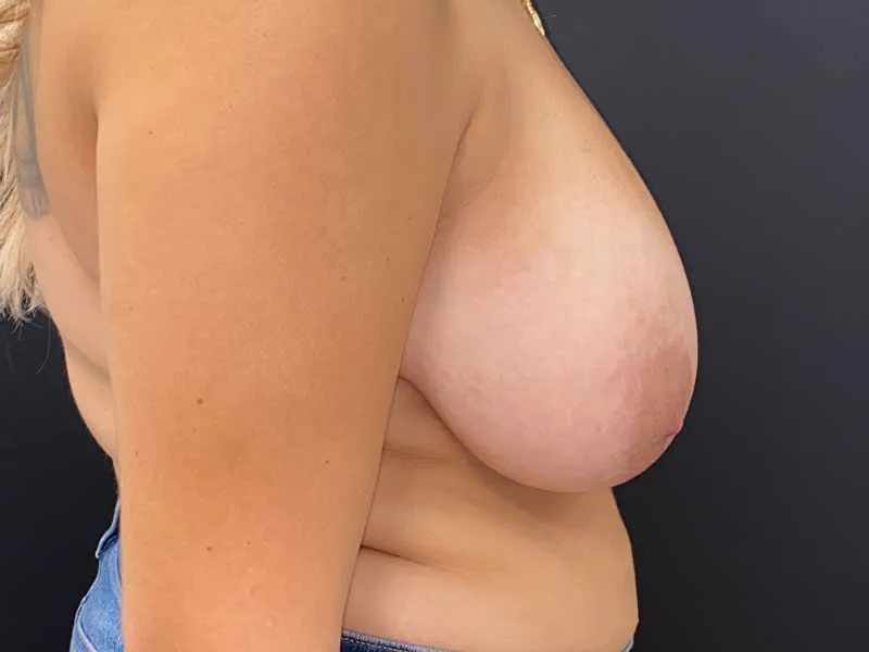 Breast Reduction before — Breast Reduction, view 3