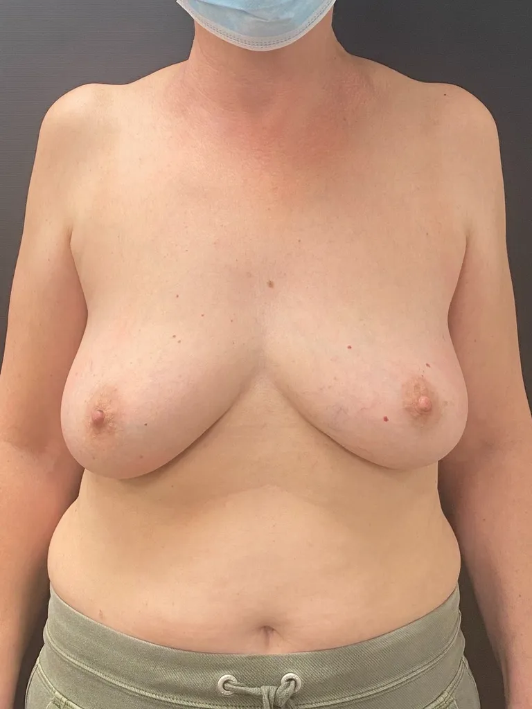 Breast Reconstruction before — Breast Reconstruction, view 1