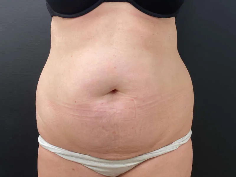 Tummy Tuck and Liposuction before — Tummy Tuck and Liposuction, view 1