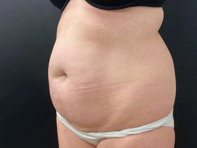 Tummy Tuck and Liposuction before — Tummy Tuck and Liposuction, view 2