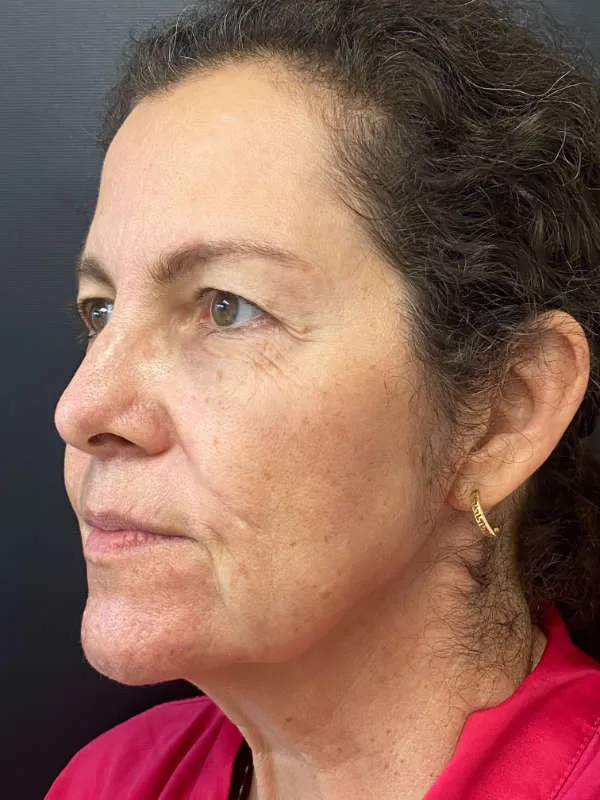 Laser Skin Resurfacing before — Laser Resurfacing, view 2