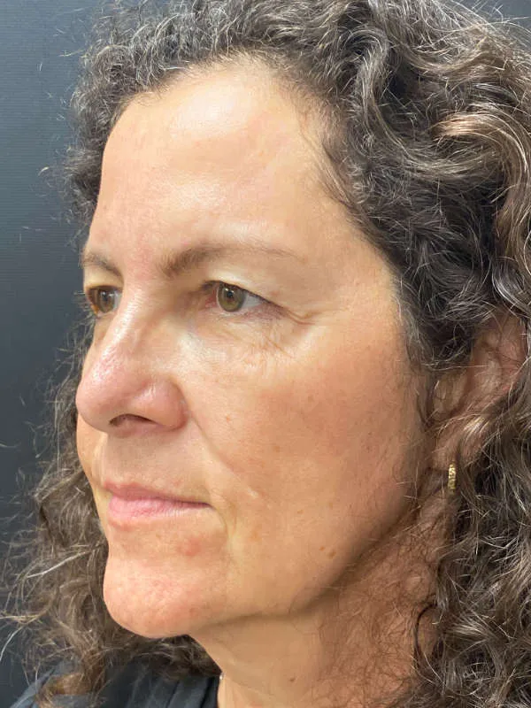 Laser Skin Resurfacing after — Laser Resurfacing, view 2
