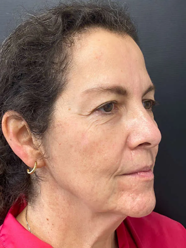 Laser Skin Resurfacing before — Laser Resurfacing, view 3