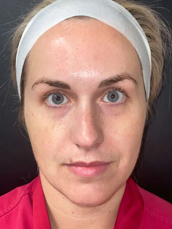 Laser Skin Resurfacing after — Laser Resurfacing, view 1