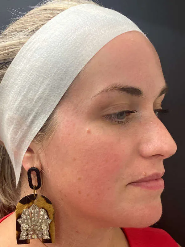 Laser Skin Resurfacing before — Laser Resurfacing, view 3