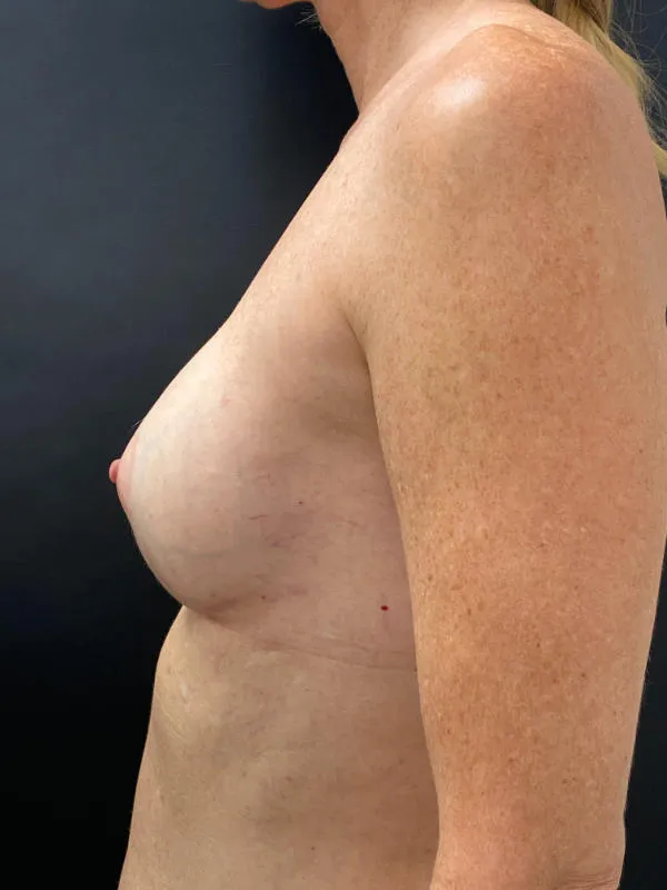 Breast Reconstruction before — Breast Reconstruction, view 3