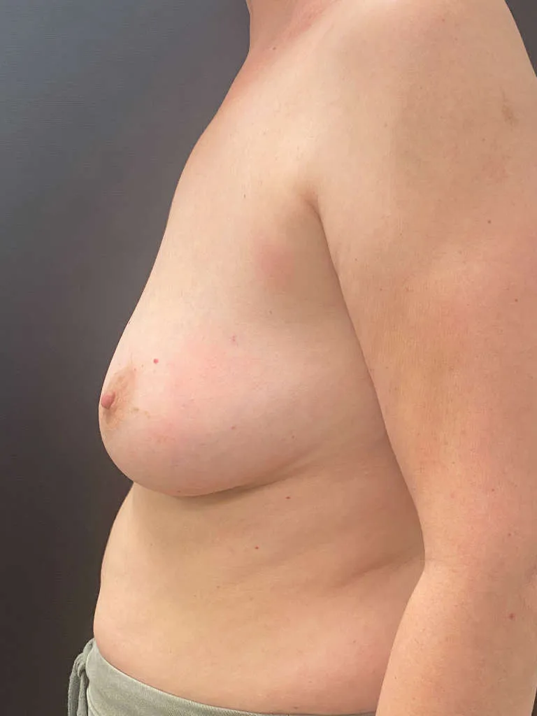 Breast Reconstruction before — Breast Reconstruction, view 3