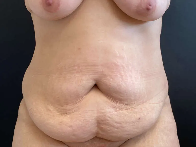 Tummy Tuck and Liposuction before — Tummy Tuck and Liposuction, view 1