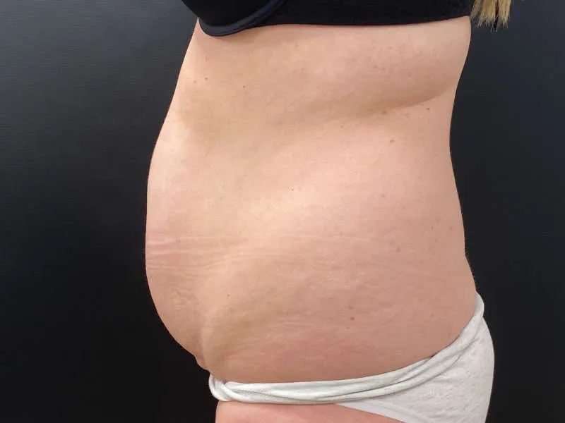 Tummy Tuck and Liposuction before — Tummy Tuck and Liposuction