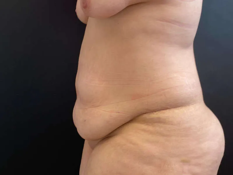 Tummy Tuck and Liposuction before — Tummy Tuck and Liposuction