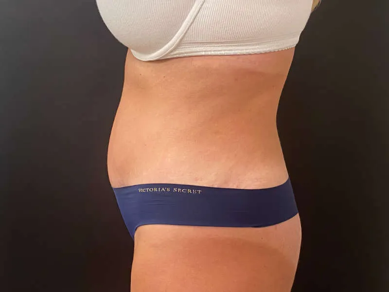Tummy Tuck and Liposuction after — Tummy Tuck and Liposuction