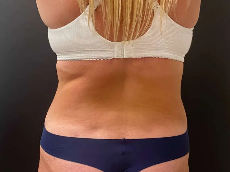 Tummy Tuck and Liposuction after — Tummy Tuck and Liposuction, view 3