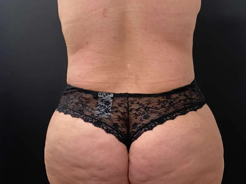 Tummy Tuck and Liposuction after — Tummy Tuck and Liposuction, view 3