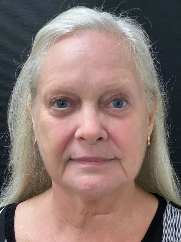 Laser Skin Resurfacing after — Laser Resurfacing, view 1