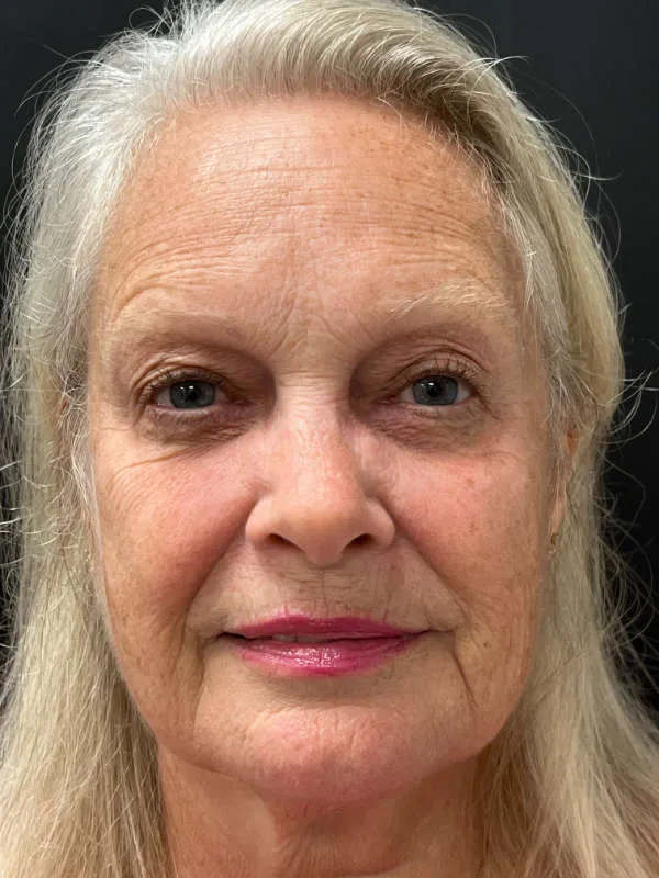 Laser Skin Resurfacing before — Laser Resurfacing, view 1