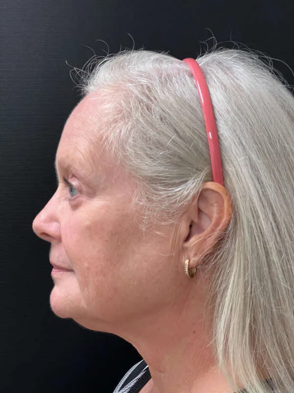 Laser Skin Resurfacing after — Laser Resurfacing, view 2