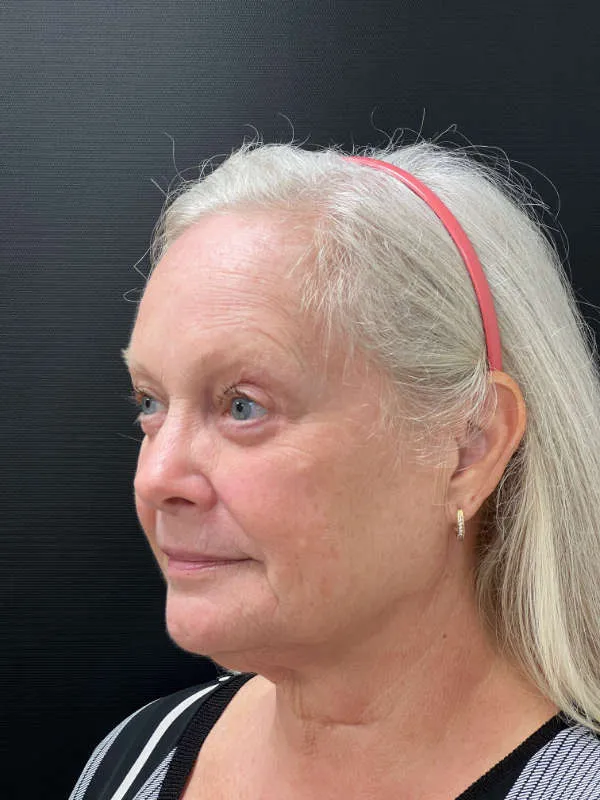 Laser Skin Resurfacing after — Laser Resurfacing, view 3