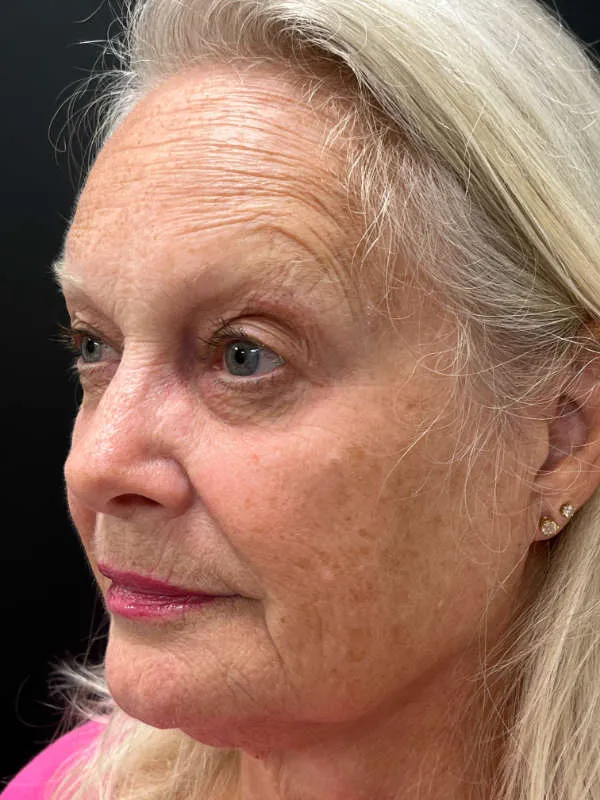 Laser Skin Resurfacing before — Laser Resurfacing, view 3