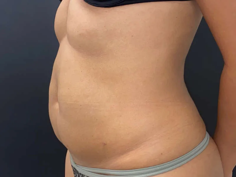 Tummy Tuck and Liposuction before — Tummy Tuck and Liposuction, view 2