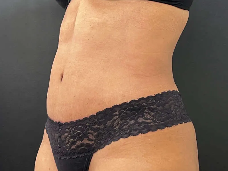 Tummy Tuck and Liposuction after — Tummy Tuck and Liposuction, view 2