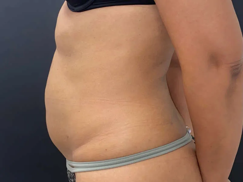 Tummy Tuck and Liposuction before — Tummy Tuck and Liposuction, view 3