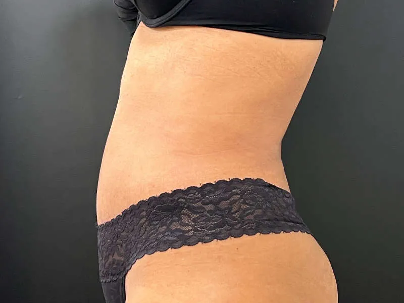 Tummy Tuck and Liposuction after — Tummy Tuck and Liposuction, view 3