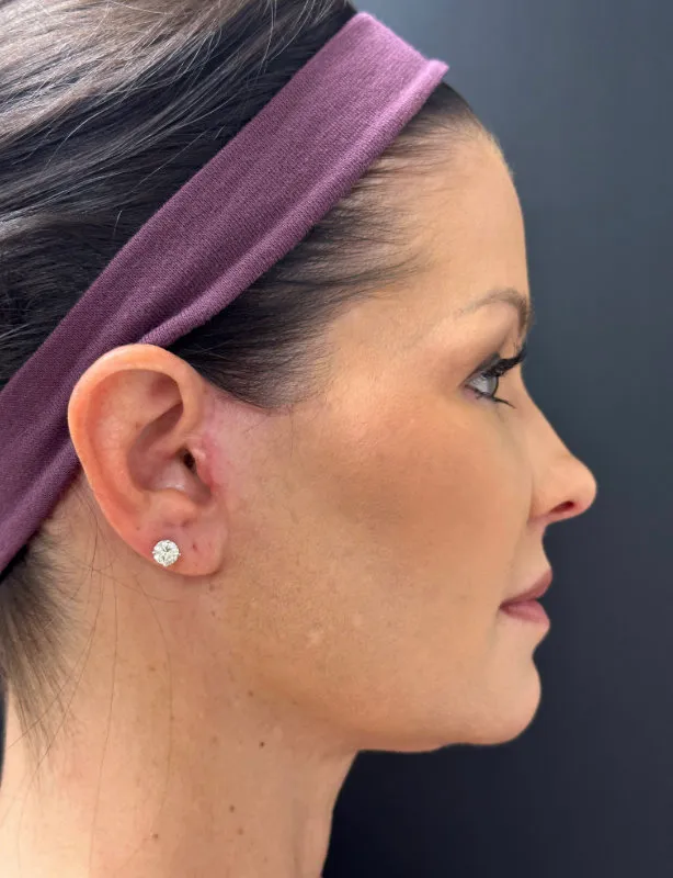 Facelift after — Lower Face and Neck Muscle Repair “Mini Facelift”, view 3