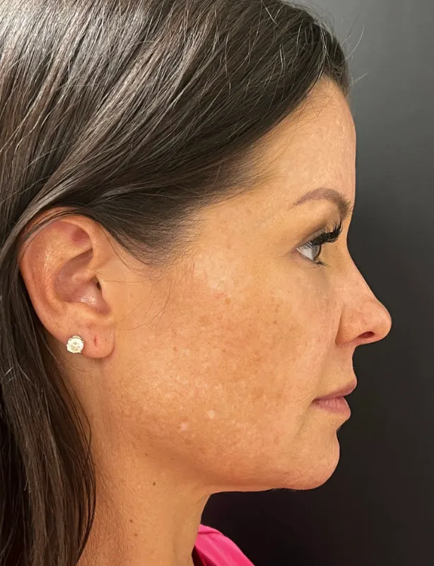 Facelift before — Lower Face and Neck Muscle Repair “Mini Facelift”, view 3