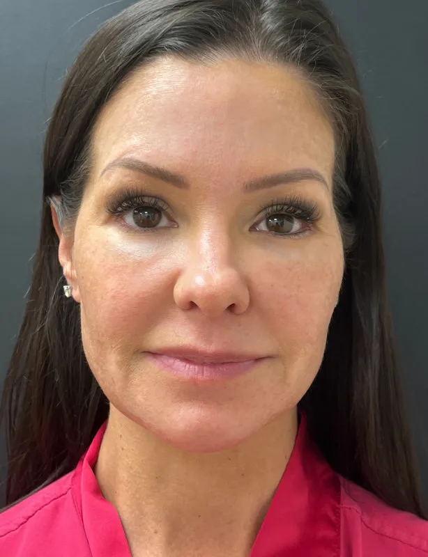 Facelift before — Lower Face and Neck Muscle Repair “Mini Facelift”, view 1