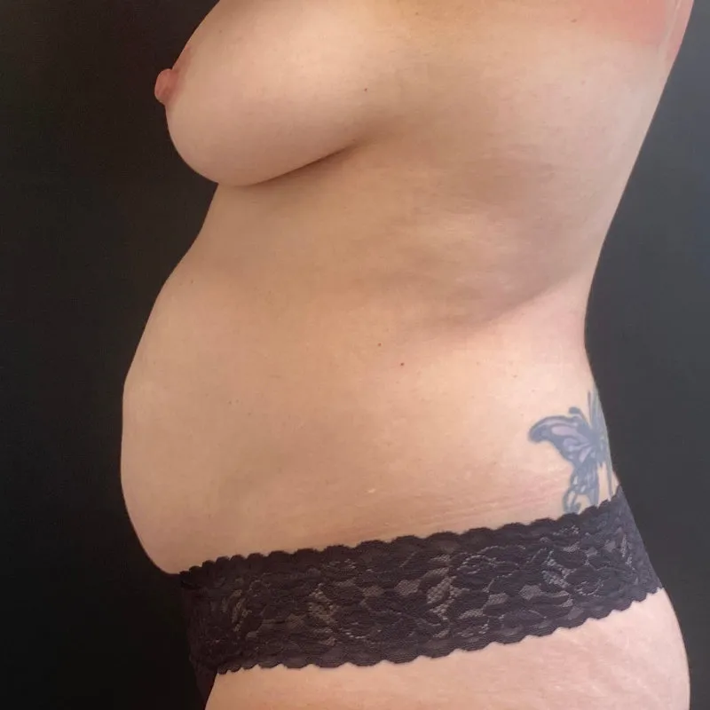 Tummy Tuck and Liposuction before — Tummy Tuck and Liposuction, view 3