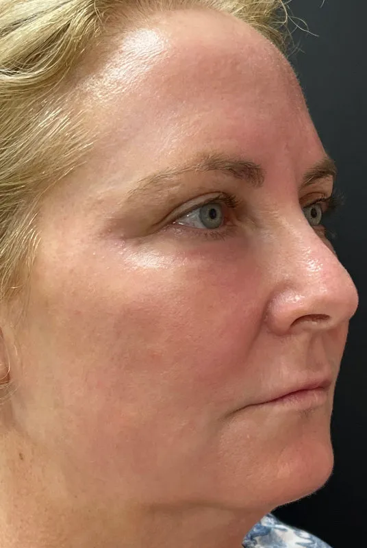 Phenol Peel after — Phenol Peel, view 3