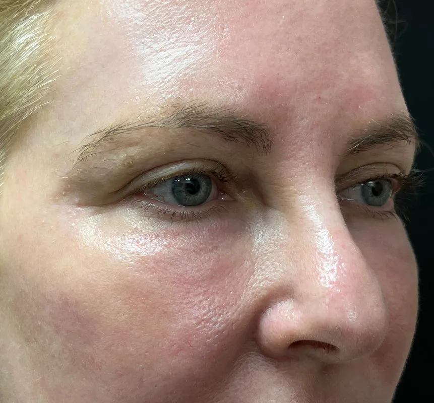 Phenol Peel after — Phenol Peel