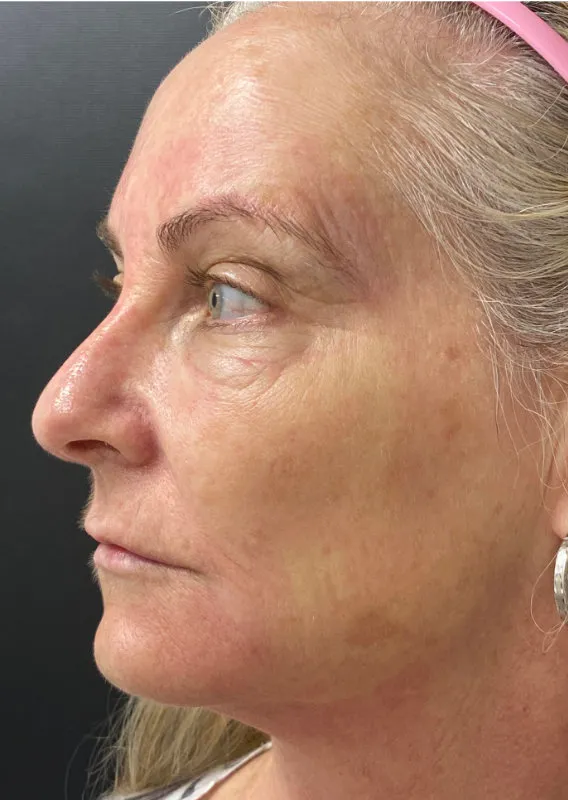 Phenol Peel before — Phenol Peel, view 2