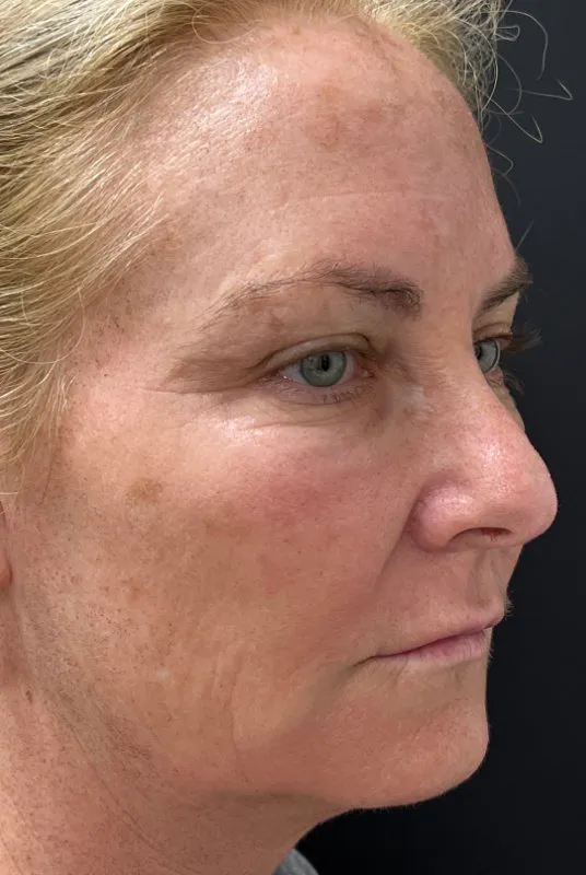 Phenol Peel before — Phenol Peel, view 3