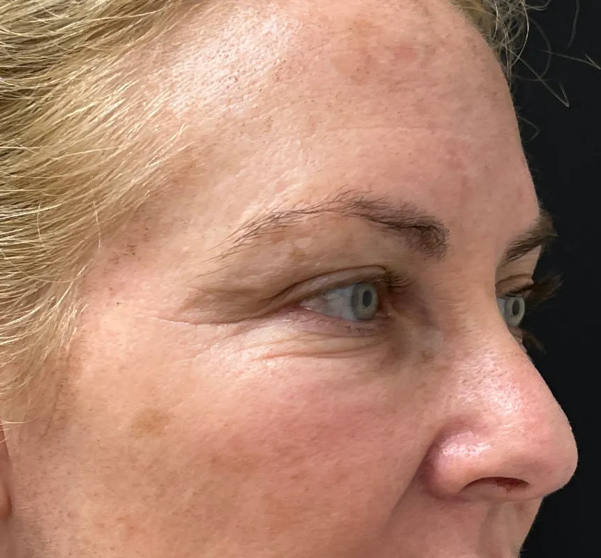 Phenol Peel before — Phenol Peel