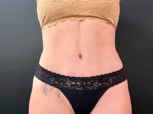 Tummy Tuck and Liposuction after — Tummy Tuck and Liposuction, view 1