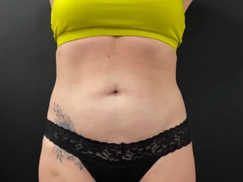 Tummy Tuck and Liposuction before — Tummy Tuck and Liposuction, view 1