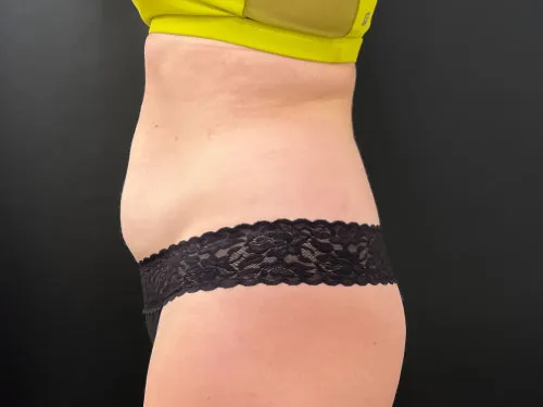 Tummy Tuck and Liposuction before — Tummy Tuck and Liposuction, view 3