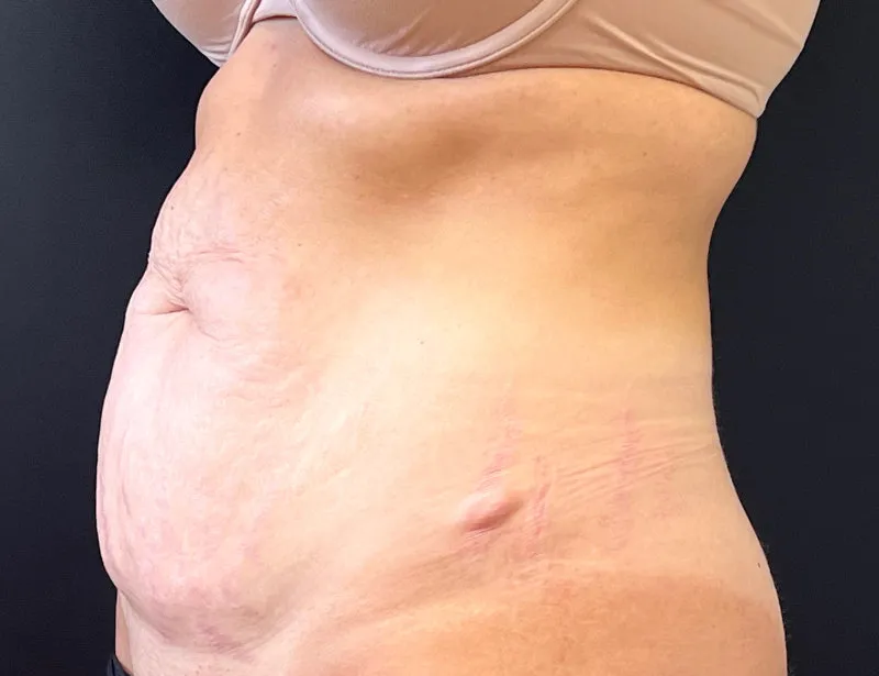 Tummy Tuck and Liposuction before — Tummy Tuck and Liposuction, view 2