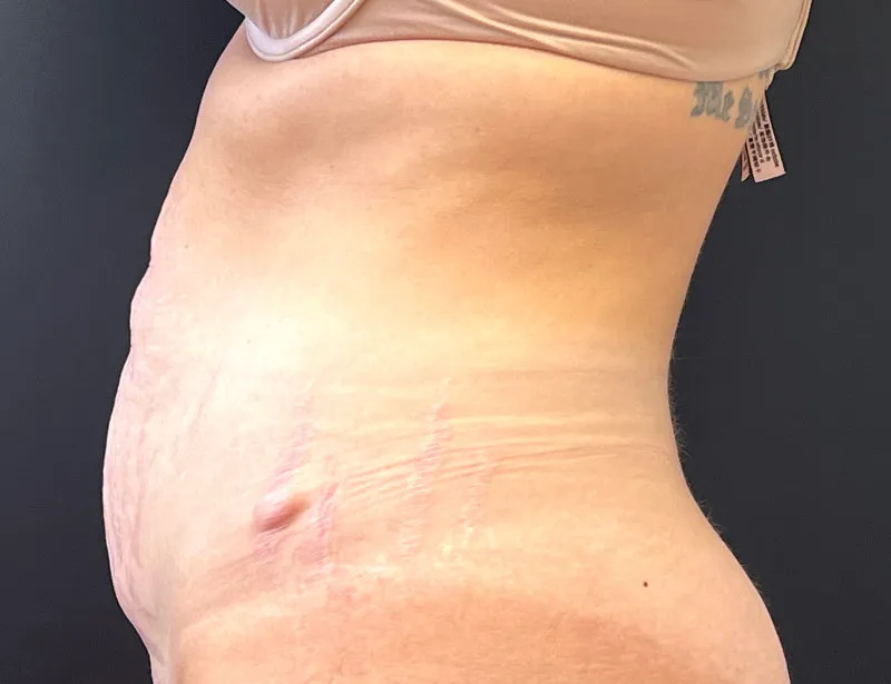Tummy Tuck and Liposuction before — Tummy Tuck and Liposuction, view 3