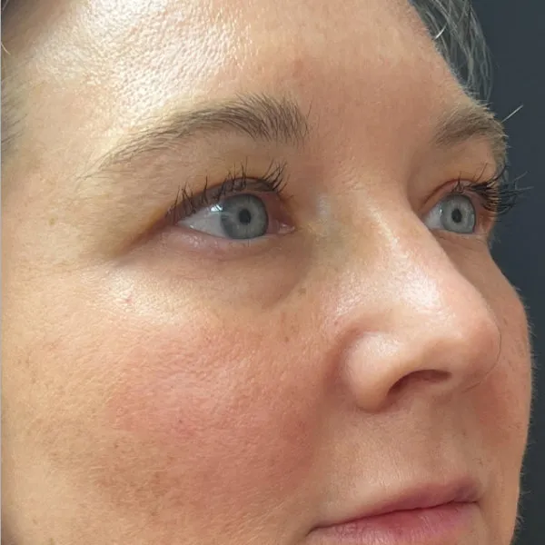 Laser Skin Resurfacing after — Laser Resurfacing, view 1