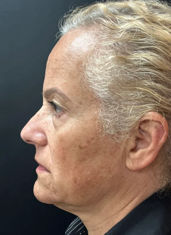 Laser Skin Resurfacing before — Laser Resurfacing, view 3
