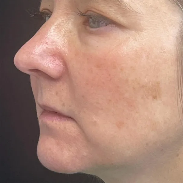 Laser Skin Resurfacing after — Laser Resurfacing, view 2