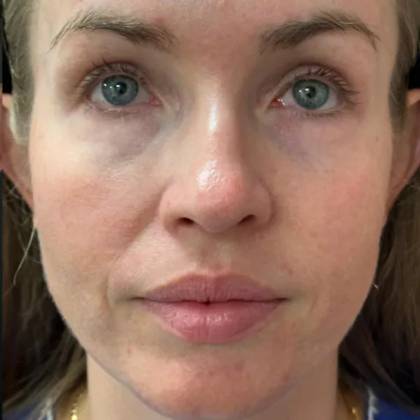 Laser Skin Resurfacing after — Laser Resurfacing, view 1