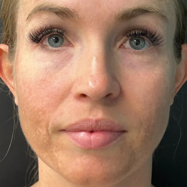 Laser Skin Resurfacing before — Laser Resurfacing, view 1