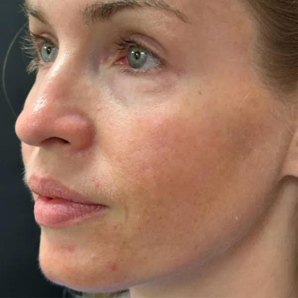 Laser Skin Resurfacing after — Laser Resurfacing, view 2
