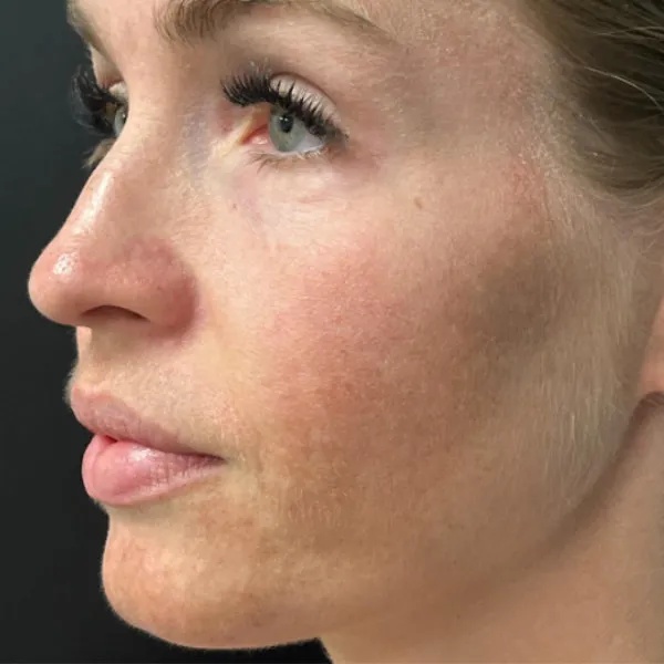 Laser Skin Resurfacing before — Laser Resurfacing, view 2