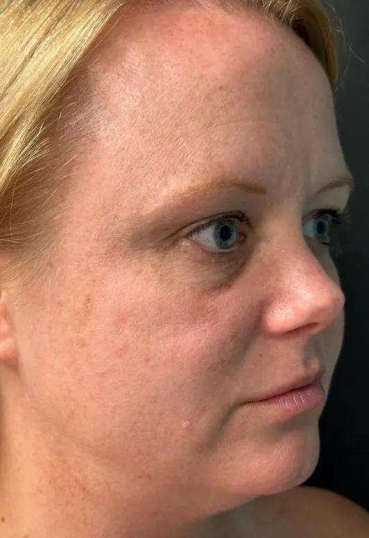 Laser Skin Resurfacing after — Laser Resurfacing, view 2