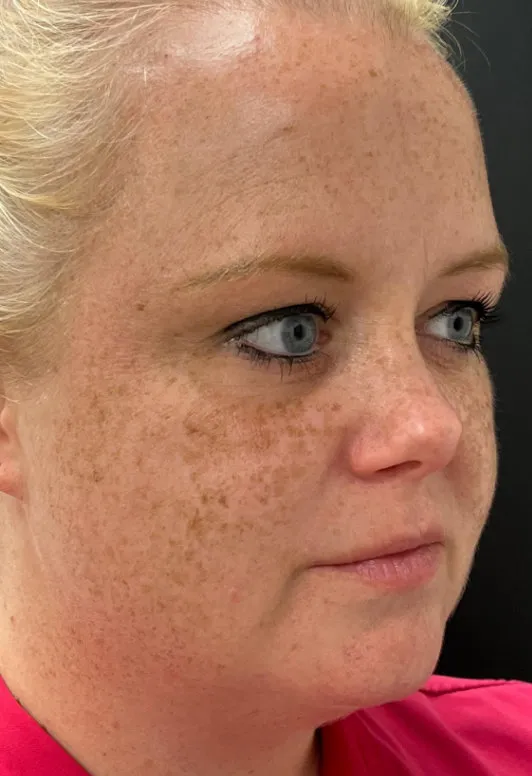 Laser Skin Resurfacing before — Laser Resurfacing, view 2